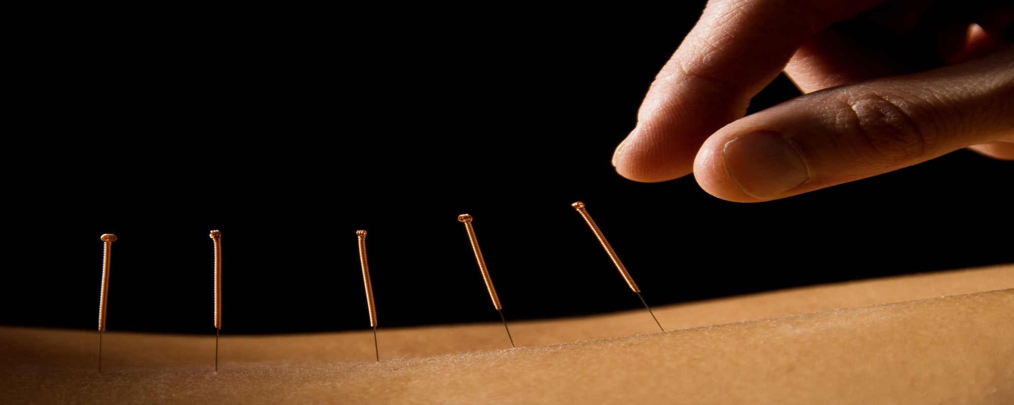 Acupunctura este un exemplu de asistenta medicala holistica