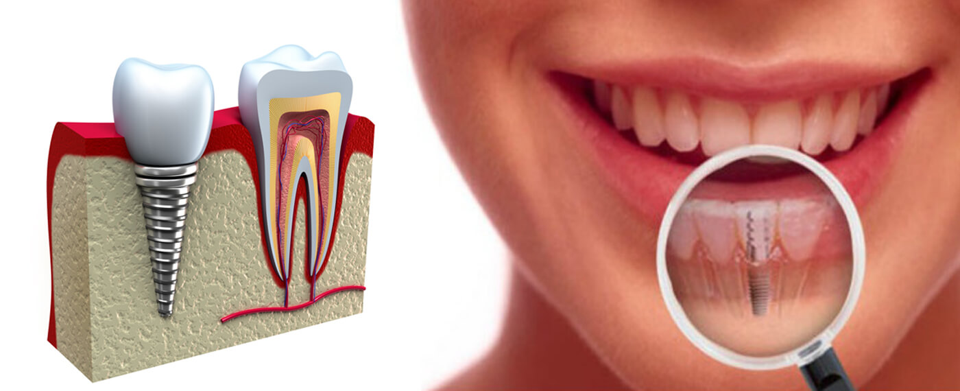 Implant dentar Iasi, la indemana ta