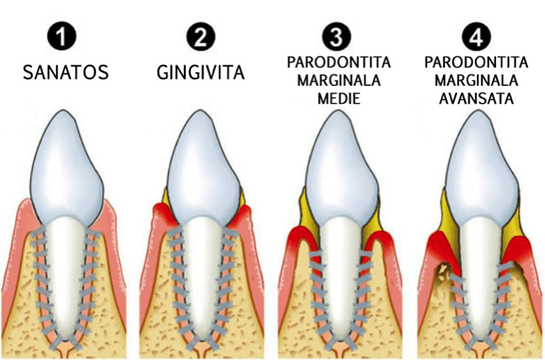 Ce este parodontita?