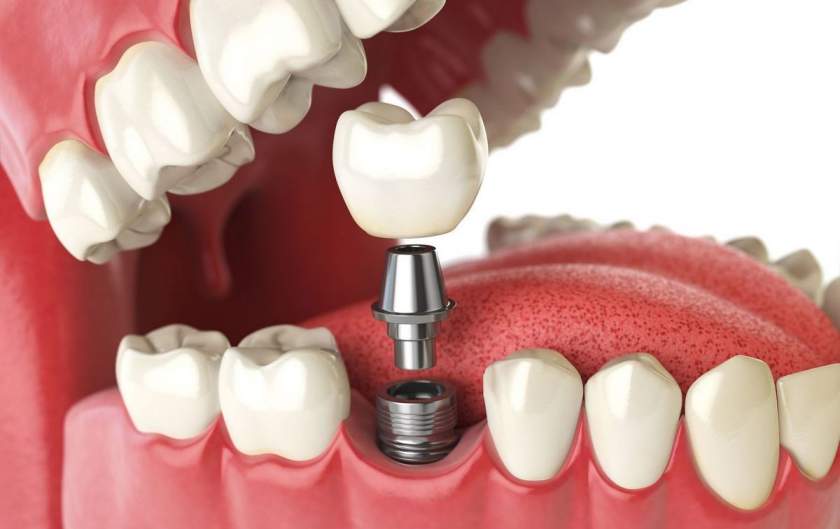 Informatii generale despre implanturile dentare