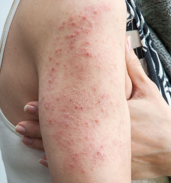 Ce este dermatita?