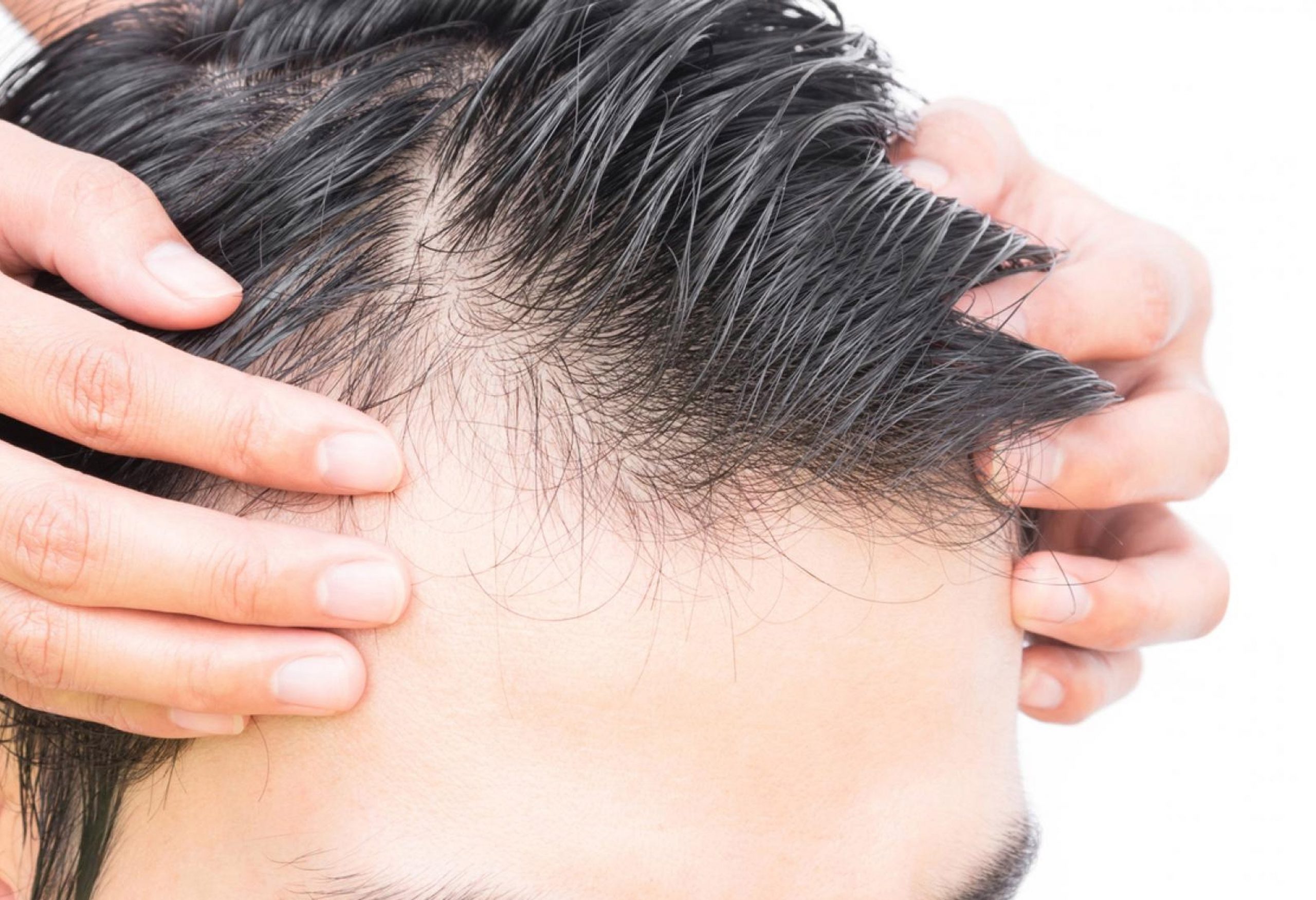Alopecia: cea mai inestetica problema capilara a barbatilor si femeilor. Afla cum o poti combate eficient!